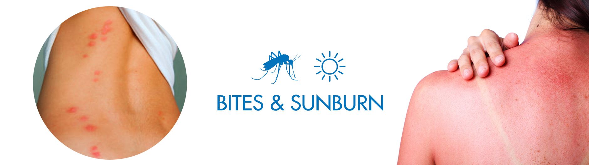 Bites and sunburns